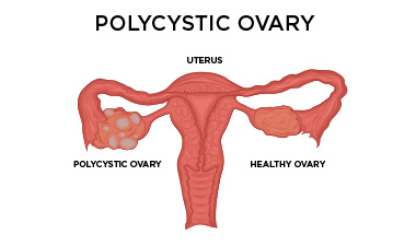 Constant Bleeding Pcos 2024