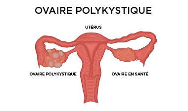 Le syndrome des ovaires polykystiques (SOPK) et la santé mentale
